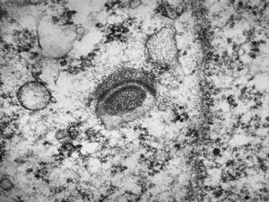 M,12y. | intracytoplasmic desmosome - pineal germinoma M,12y. | intracytoplasmic desmosome - pineal germinoma